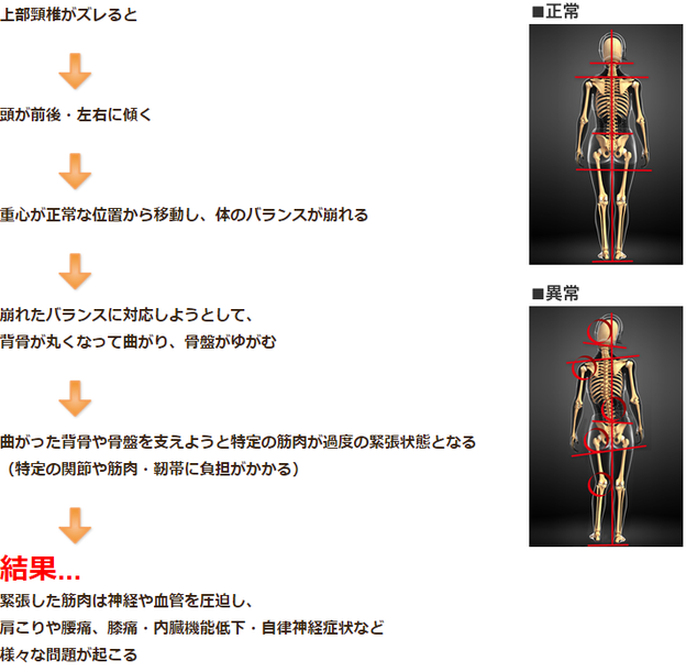 正常な体全体のの骨格と-ゆがんだ骨格を比較したイラスト画像