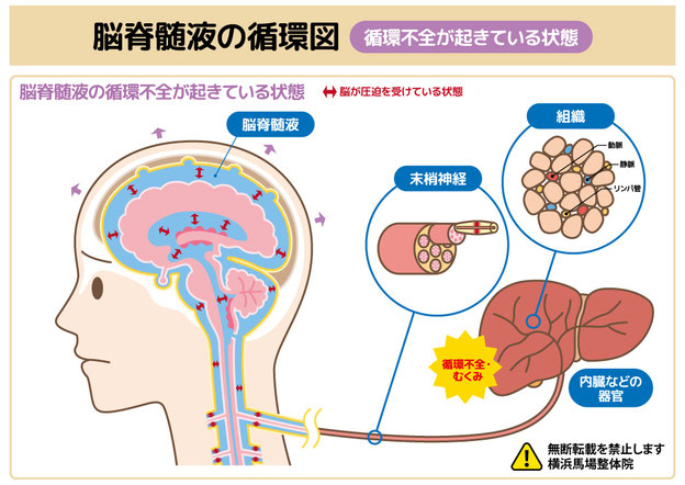 脳脊髄液の循環図（循環不全が起きている状態）